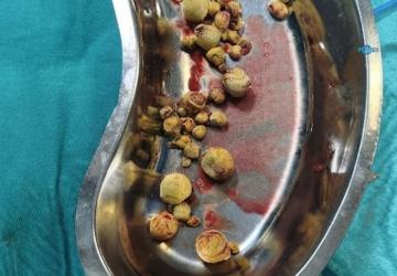 Kahta’da 82 yaşındaki hastanın mesanesinden 42 parça taş çıkarıldı
