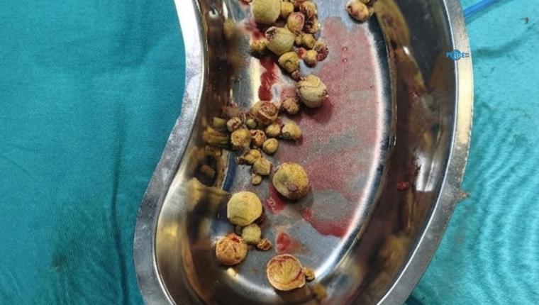 Kahta’da 82 yaşındaki hastanın mesanesinden 42 parça taş çıkarıldı
